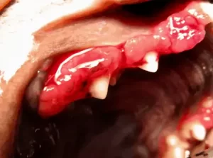 juvenilni gingivitis